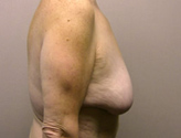 Patient # 10255 Before Photo # 5