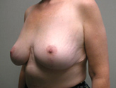 Patient # 32727 After Photo # 4