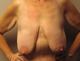 Patient # 32727 Before Photo # 1