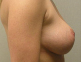 Patient # 34883 After Photo # 6