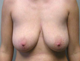 Patient # 34883 Before Photo # 1