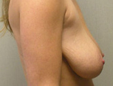 Patient # 34883 Before Photo # 5