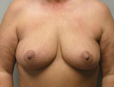 Patient # 98457 After Photo # 2