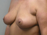 Patient # 98457 After Photo # 4