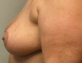 Patient # 98457 After Photo # 6