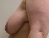 Patient # 98457 Before Photo # 5