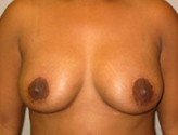 Patient # 65245 After Photo # 2