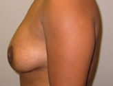 Patient # 65245 After Photo # 8