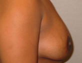Patient # 65245 After Photo # 10