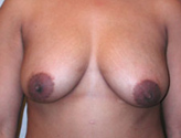 Patient # 65245 Before Photo # 1