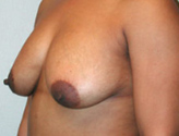 Patient # 65245 Before Photo # 3