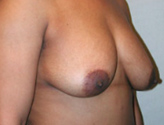 Patient # 65245 Before Photo # 5