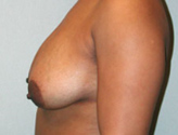Patient # 65245 Before Photo # 7