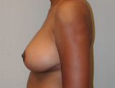 Patient # 86041 After Photo # 6