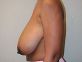 Patient # 86041 Before Photo # 5