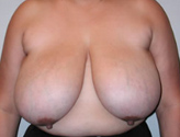Patient # 37235 Before Photo # 1