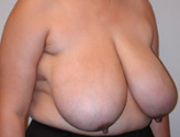 Patient # 37235 Before Photo # 3