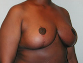 Patient # 29580 After Photo # 4