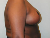 Patient # 29580 After Photo # 6