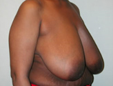 Patient # 29580 Before Photo # 3