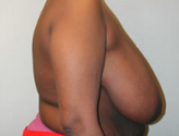 Patient # 29580 Before Photo # 5