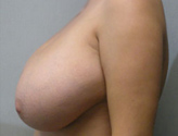 Patient # 53671 Before Photo # 5