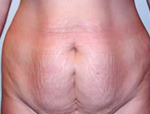 Patient # 23281 Before Photo # 1