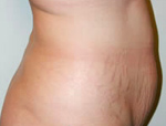 Patient # 23281 Before Photo # 5