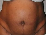 Patient # 77668 Before Photo # 1