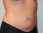 Patient # 75777 After Photo # 6
