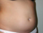 Patient # 75777 Before Photo # 5