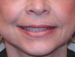 Patient # 97656 After Photo # 2
