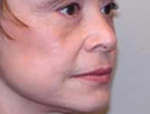 Patient # 97656 After Photo # 4