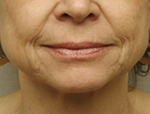 Patient # 97656 Before Photo # 1
