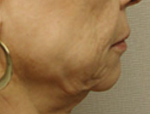 Patient # 97656 Before Photo # 5