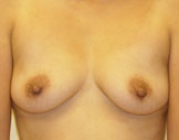 Patient # 24292 Before Photo # 1