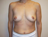 Patient # 91230 Before Photo # 1