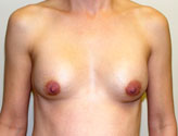 Patient # 24398 Before Photo # 1