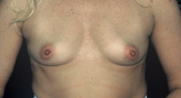 Patient # 31103 Before Photo # 1