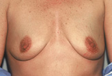 Patient # 61976 Before Photo # 1