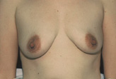 Patient # 15078 Before Photo # 1