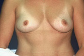 Patient # 66854 Before Photo # 1