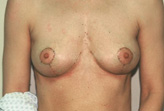 Patient # 74225 After Photo # 2