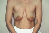 Patient # 74225 Before Photo # 1