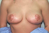 Patient # 44479 After Photo # 2