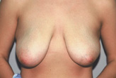 Patient # 44479 Before Photo # 1