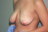 Patient # 44479 Before Photo # 3