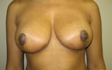 Patient # 16267 After Photo # 2