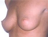 Patient # 28532 Before Photo # 1