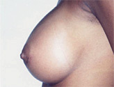 Patient # 97583 After Photo # 2